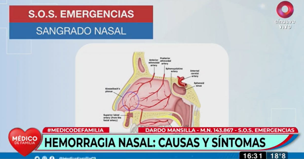 ¿Te sangra la nariz con frecuencia? Mirá estos consejos para saber qué ...